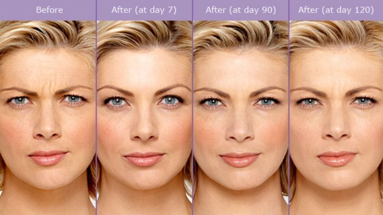 How Botox and Fillers Work